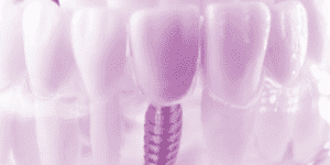 Fort Worth Dental Implants Dentist