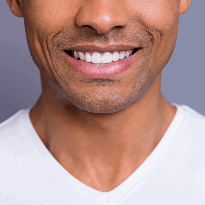 White teeth, cosmetic dentistry patient, fort worth